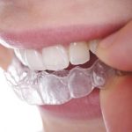 memasang invisalign
